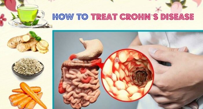 14 Self-Care Tips for Crohn's Disease
